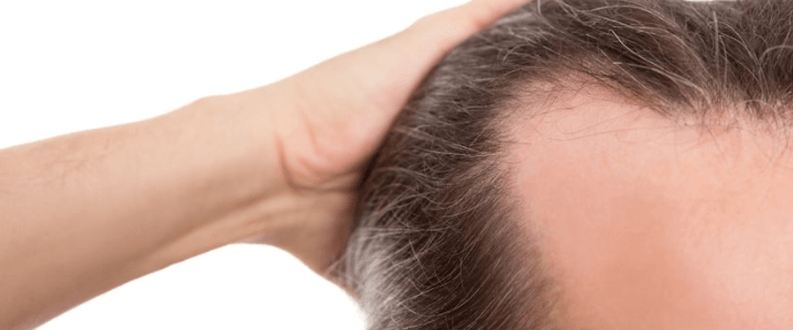 Klinische Studie zu Minoxidil