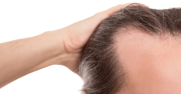 Klinische Studie zu Minoxidil