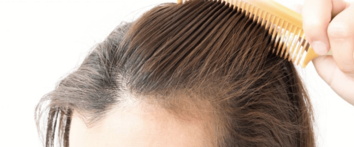 Studie zu Haarausfall bei Frauen