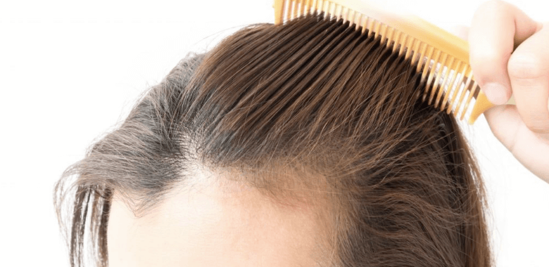 Studie zu Haarausfall bei Frauen